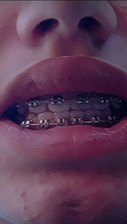 bracesfetish OnlyFans Leaked (33 Photos and 0 Videos) 

 picture 2